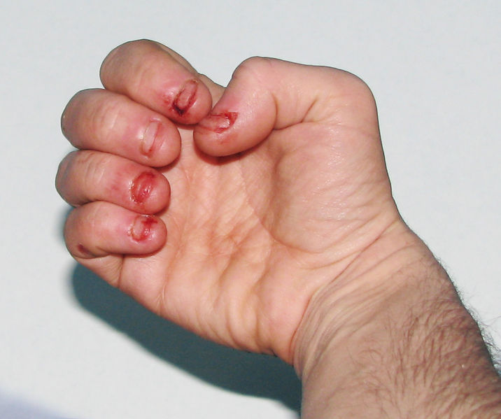 Soubor:Dermatophagia.jpg