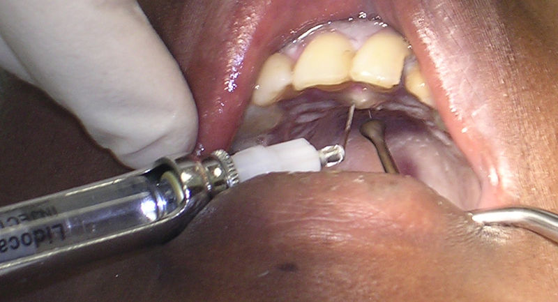 Soubor:DentalLocalAnesthesia11-26-05.jpg