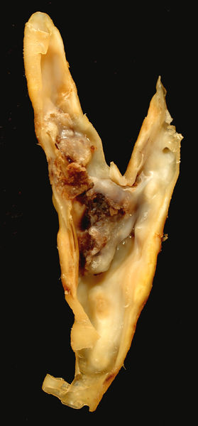 Soubor:Carotid Plaque.jpg