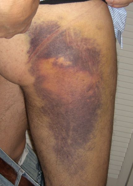 Soubor:Hematoma Feb 07.jpg