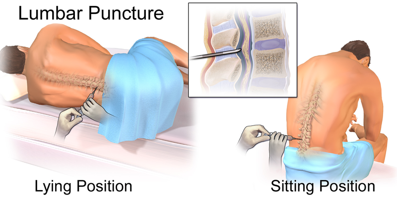 Soubor:Blausen 0617 LumbarPuncture.png