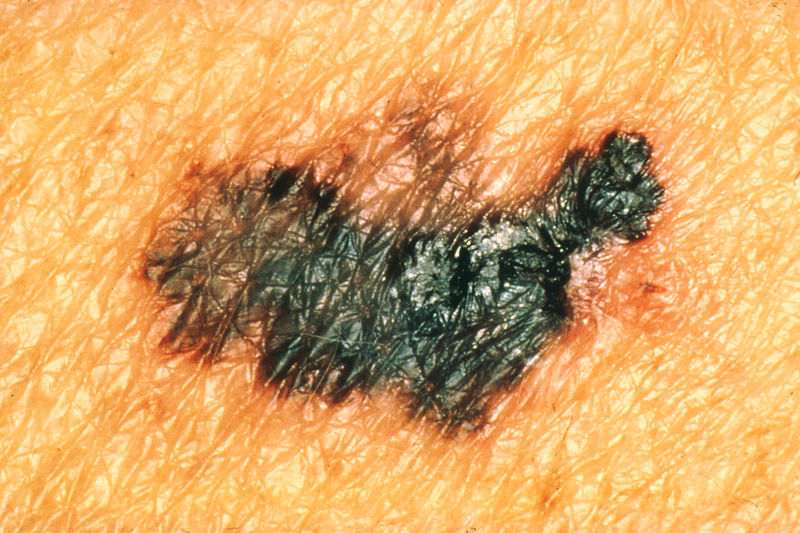 Soubor:Melanoma1.jpg